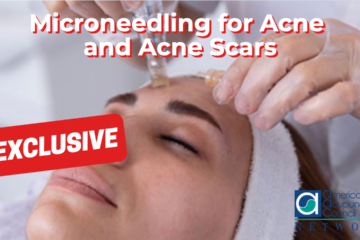 Microneedling for Acne and Acne Scars
